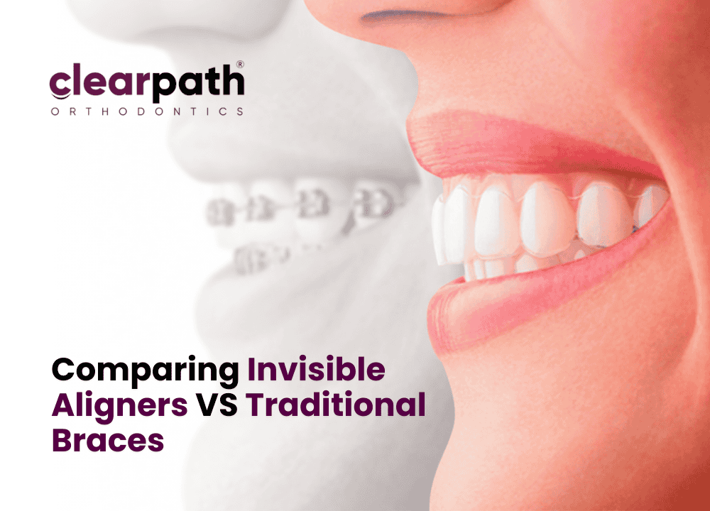 Invisible Aligners VS Traditional Braces
