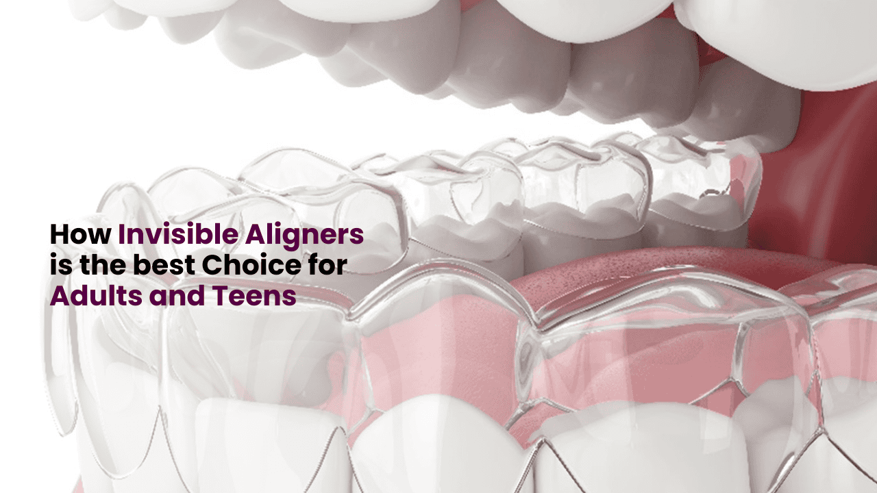 clear aligners for adults and teens