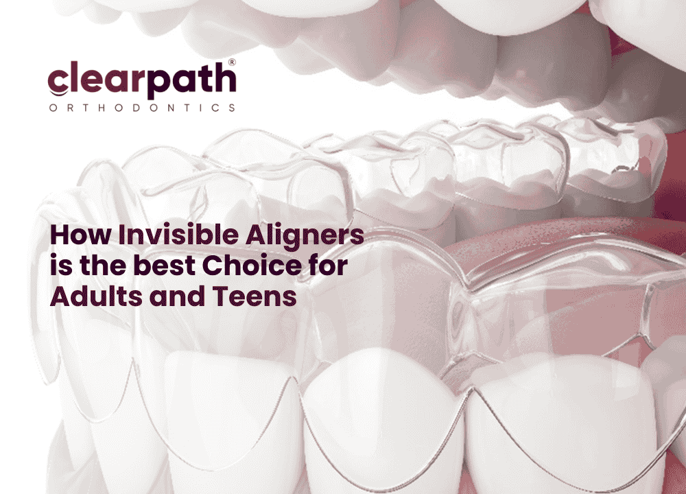 clear aligners for adults and teens